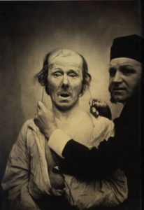 Duchenne de Boulogne - Mécanisme de la physionomie -étude de l'électricité sur le visage d'un patient 